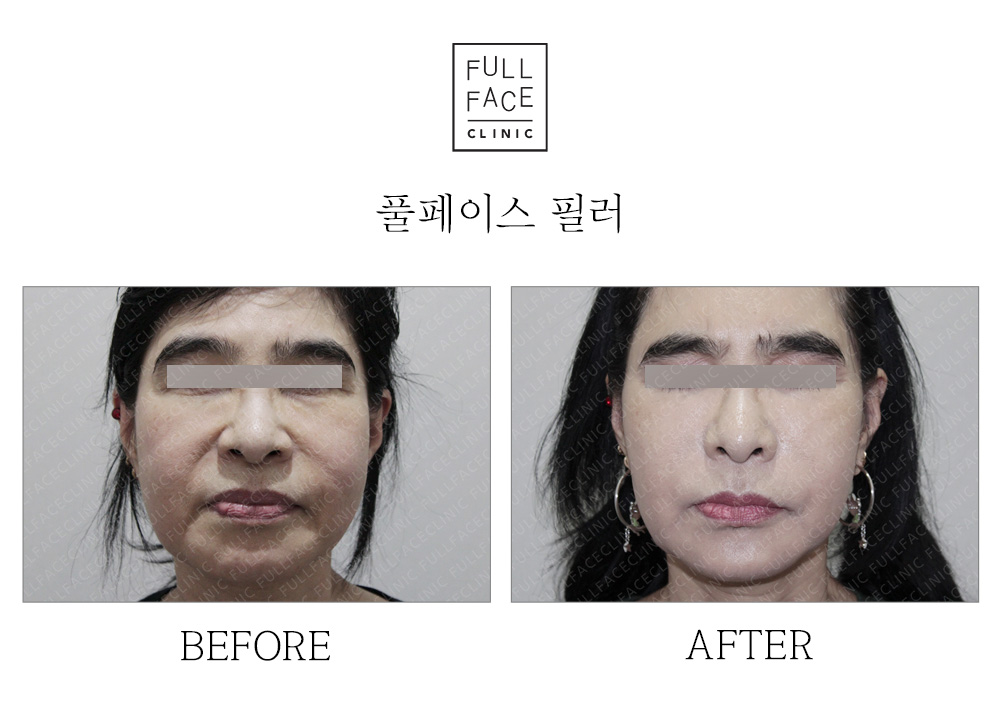 풀페이스 필러 전후사진