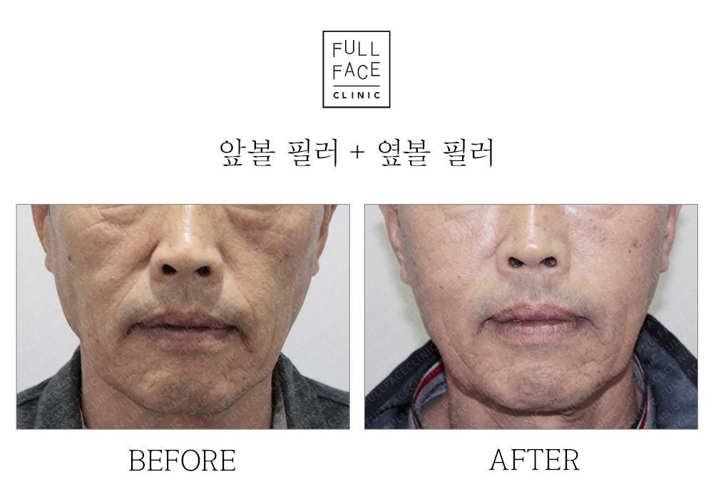 앞볼 옆볼 필러 전후사진