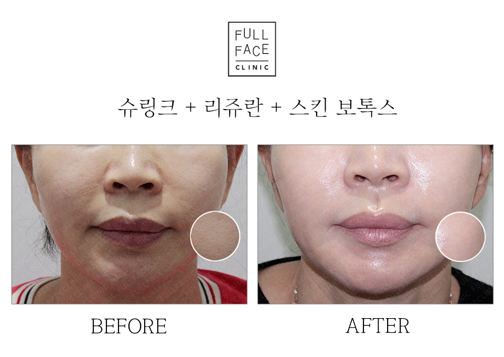 Skin Booster