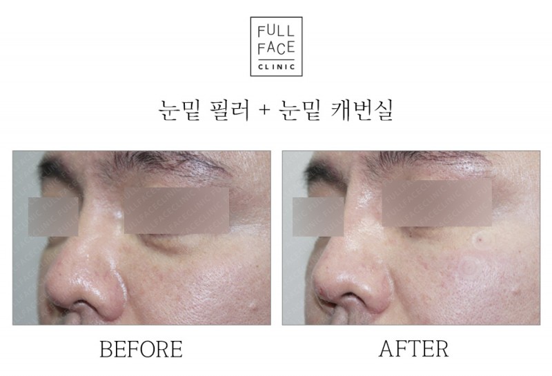 Filler