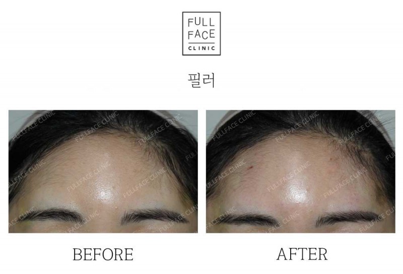 Filler