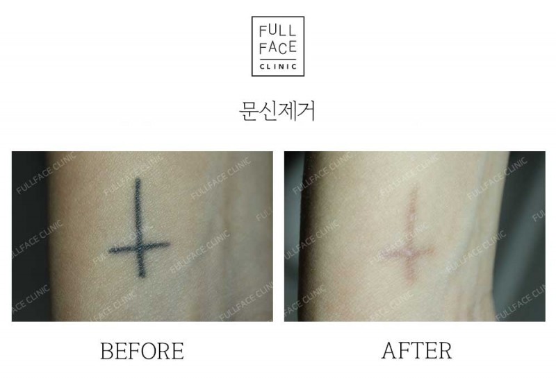 Tatoo Removal