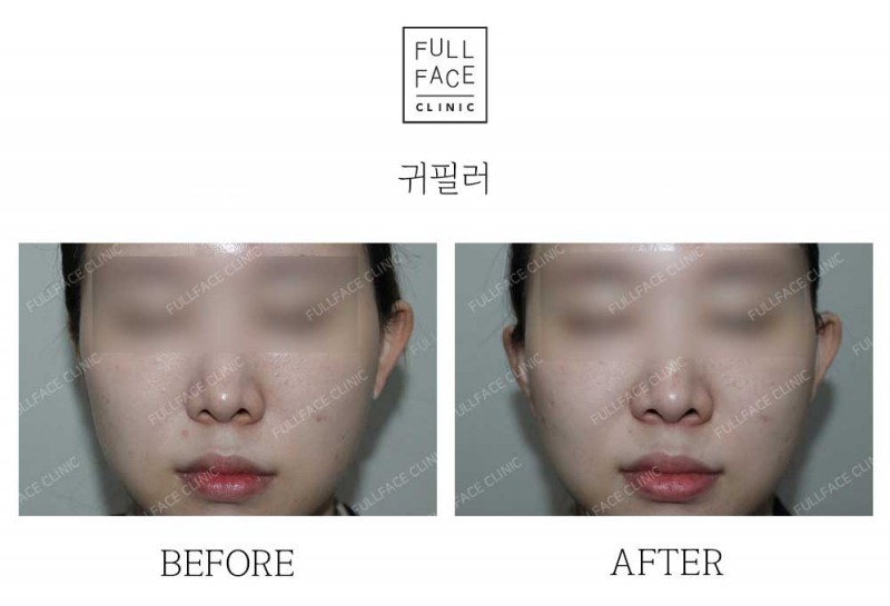 Filler
