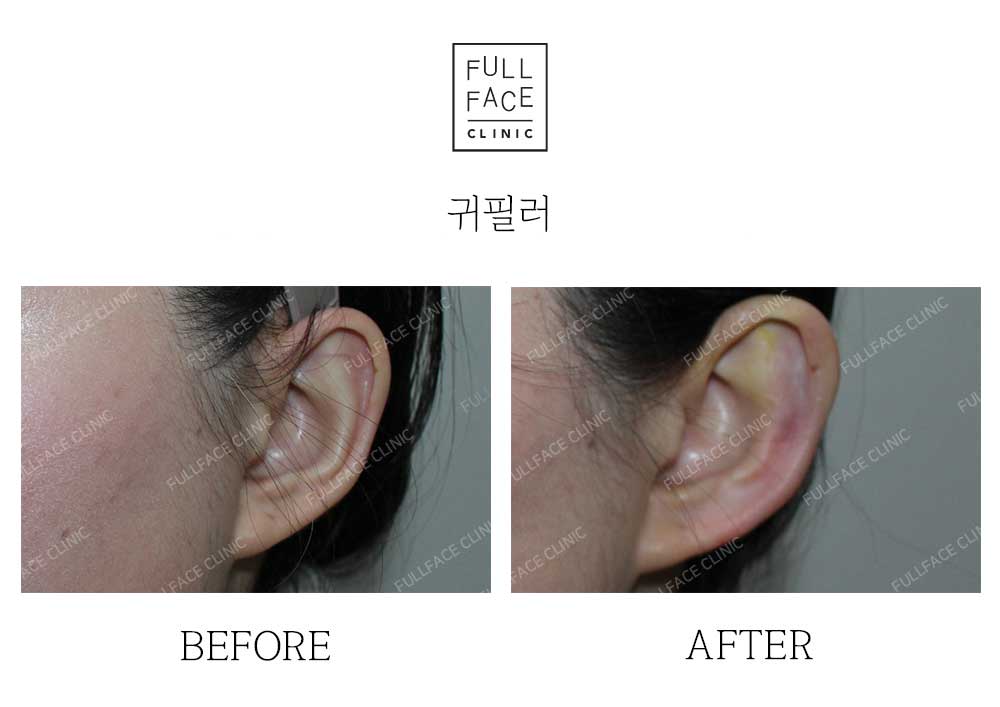 Filler