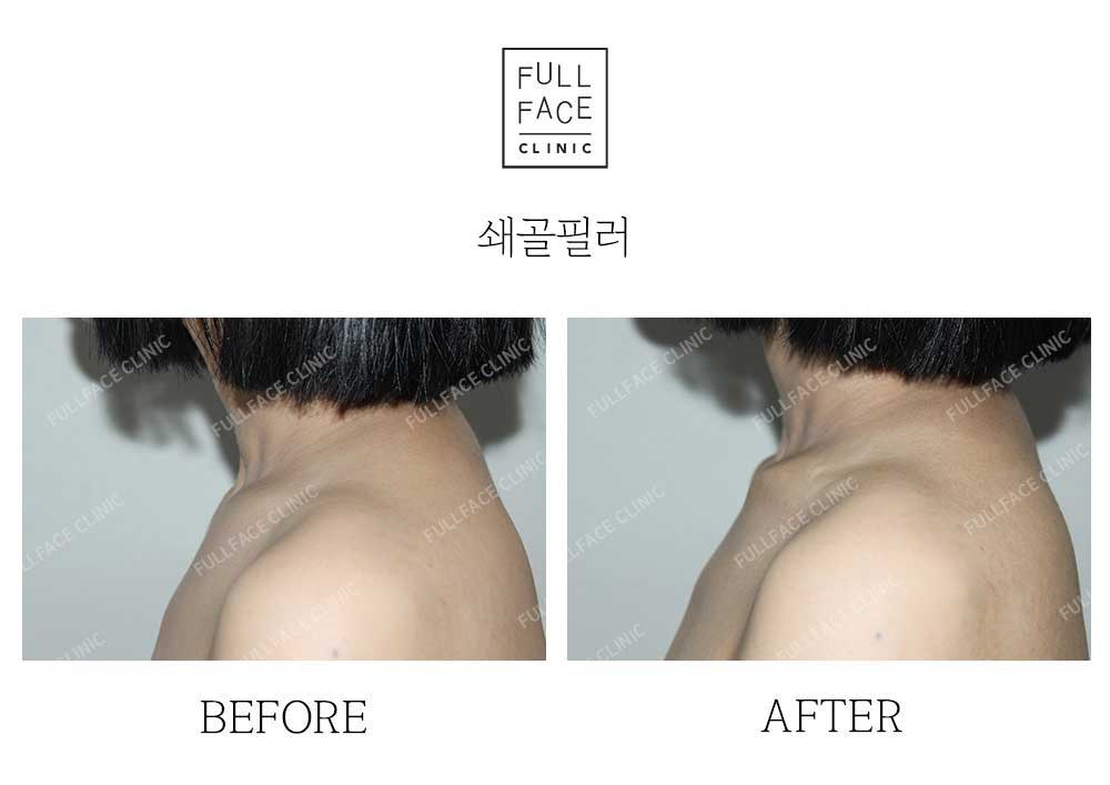 Filler