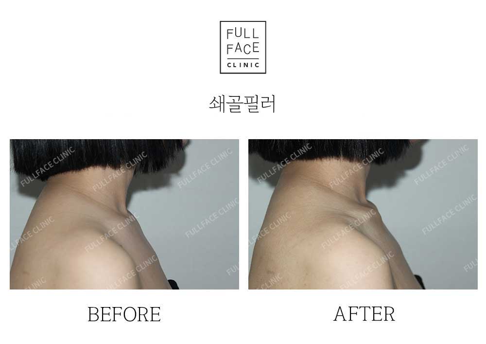 Filler