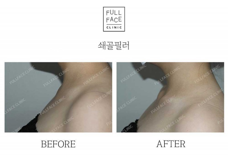 玻尿酸