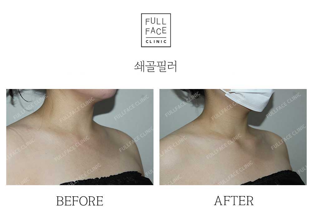 玻尿酸