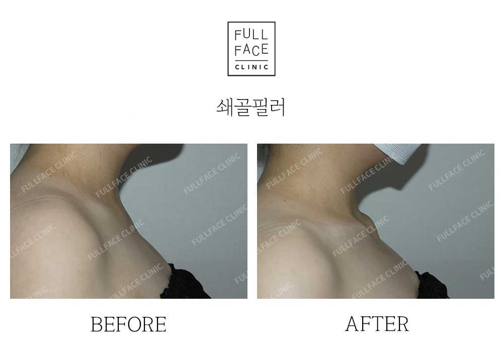 玻尿酸