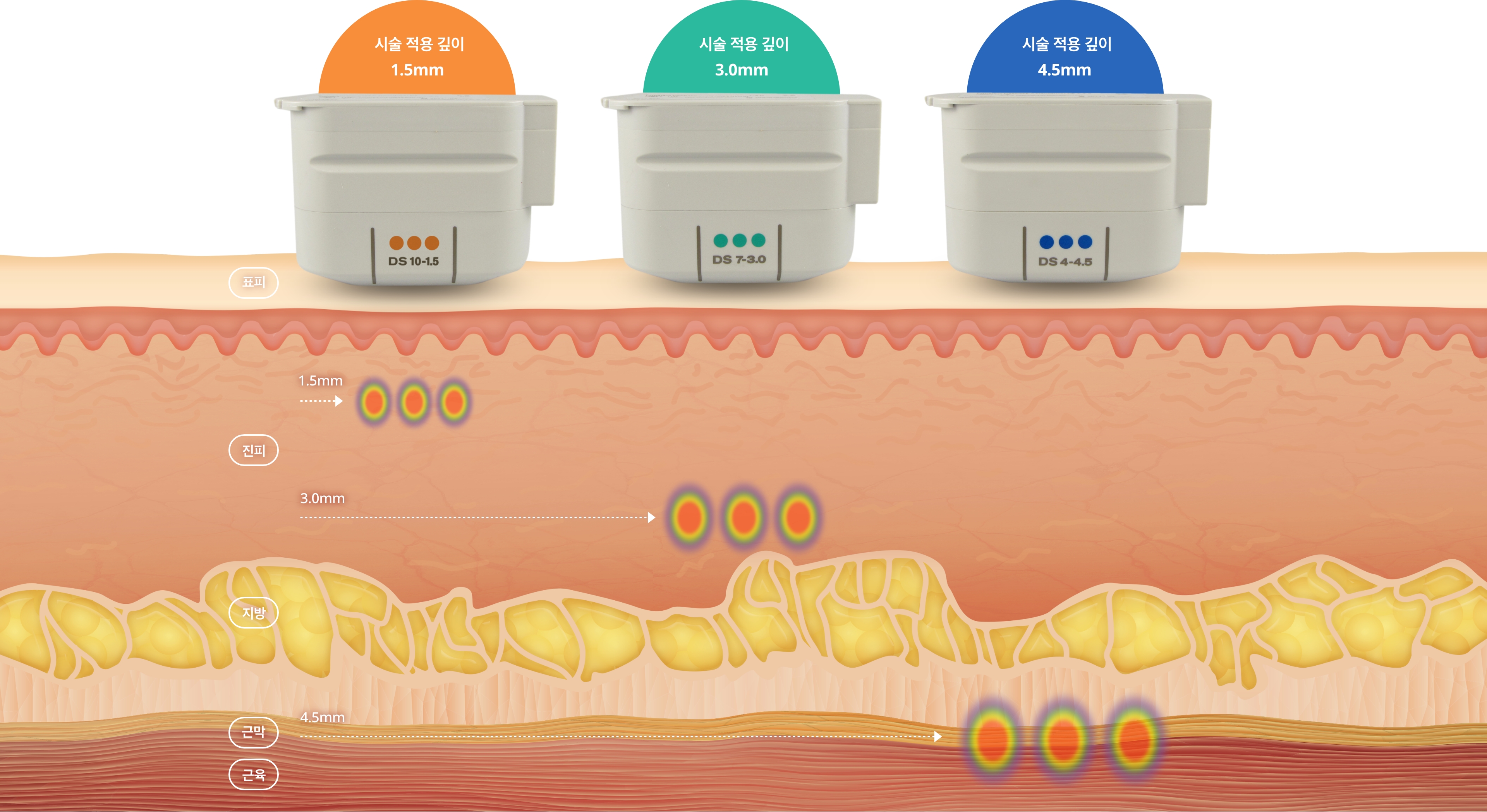 홍대 울쎄라 효과, 유지기간, 부작용