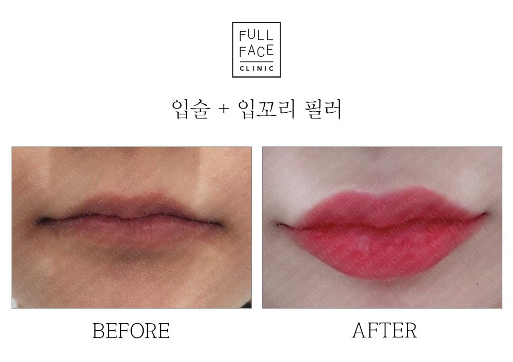 입술필러 1cc, 술, 멍, 뭉침, 빨대, 주기 모두 알려드릴게요. 신촌 피부과